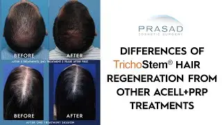 How TrichoStem Hair Regeneration is Different from Other ACell+PRP Treatments