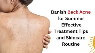 Banish Back Acne for Summer Effective Treatment Tips and Skincare Routine