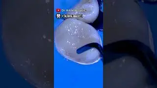 AMAZING QUICK Tooth Restoration 
