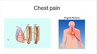 What is Angina pectoris?