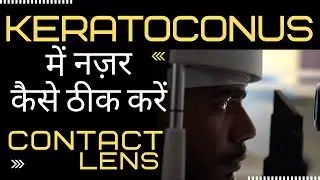 Keratoconus (करैटोकोनस) मे नज़र कैसे ठीक करें? - Best Contact Lenses for Keratoconus - Scleral Lenses