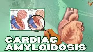 Cardiac Amyloidosis: Navigating Diagnostic Challenges and Therapeutic Horizons in 2025