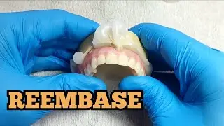 Como fazer um reembase de uma dentadura