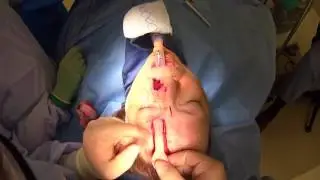 Watch how a nose can be reconstructed with a Forehead Flap