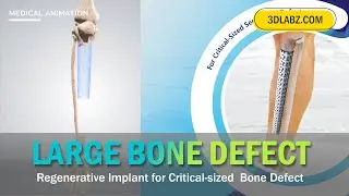 Regenerative Implant for Large Size Bone Defect | 3D Animation | PCL-TCP Custom-made Implant