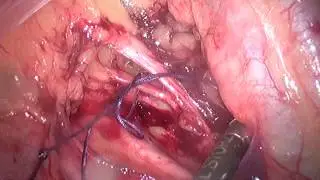 Temporary ligation if the uterine artery using the 