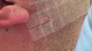 Laser co2 frazionato a Milano
