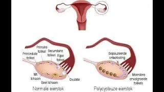 Wat is Polycysteus Ovarium Syndroom en hoe wordt het behandeld?