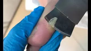Toe calluses/removal with a knife【TD Foot care】