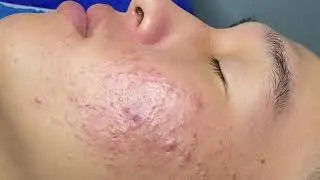 Inflammatory Acne Hematoma | Mụn Viêm Tụ Máu Dưới Da - SacDepSpa