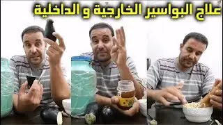علاج فعال للبواسير الخارجية و الداخلية بالمجان مع الباحث في الأعشاب
