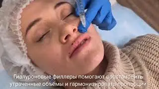 Увеличение губ гиалуроновой кислотой