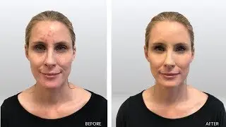 Concealer Makeup for Acne-Tutorial
