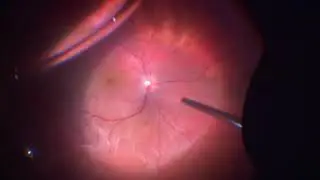 Surgery: Retinal Detachment with a Tear: Dr. Manish Nagpal
