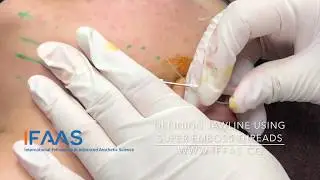 IFAAS Exclusive Technique - Defining Jawline using Super Embossed Thread
