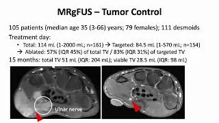 Daniel Düx: MRgFUS in Patients with Extra-Abdominal Desmoid Tumors