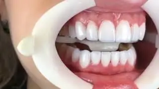 Виниры от Denta Clinic