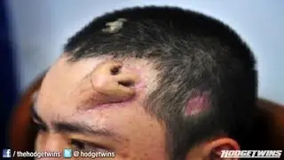 Man has Nose On His Forehead @hodgetwins