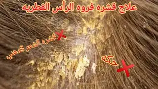 علاج قشرة الرأس الدهنية الفطريه
