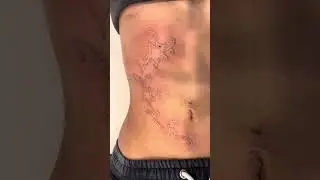 Laser Tattoo Removal