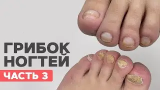 No chance | Rejected by a podologist | Toenail fungus