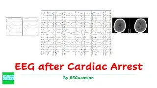 EEG After Anoxic Brain Injury