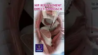 Direct Anterior Hip Replacement Surgery | Step-by-Step Medical Animation