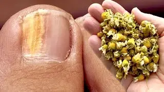Nail Fungus Removal: 100% Natural Treatment For Toenail Fungus