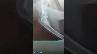 Radiographs of OSA (osteosarcoma) in a dog