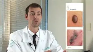 Melanoma SINAIS DE ALERTA