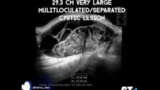Mucinous Cystadenoma Ultrasound