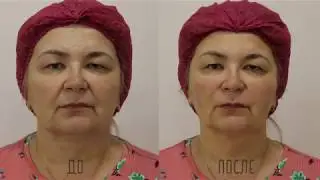 Контурная пластика препаратом Radiesse