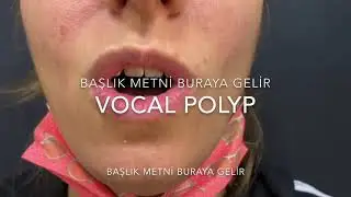 Vocal polyp