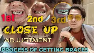 PROCESS OF GETTING BRACES|CLOSE UP ADJUSTMENT|NORHASIMOMAR|