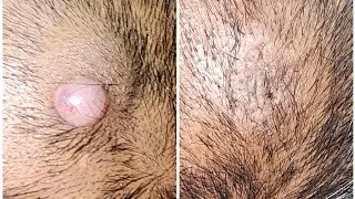 Cyst on scalp