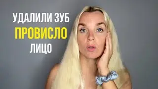 УДАЛИЛИ ЗУБ, ПРОВИСЛО ЛИЦО