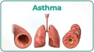 Asthma : Etiology, Pathogenesis, Clinical features, Diagnosis and Treatment