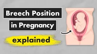Breech Baby? Your Options Explained