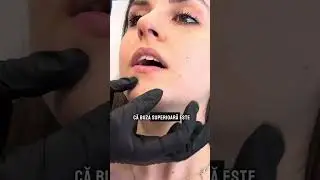 Volumizare de buze cu aspect natural