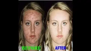 ||How to Remove Acne Pimples in Adobe Photoshop cs6 ||Photoshop tutorial ||