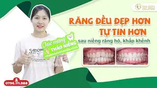 Niềng răng thành công rạng rỡ nụ cười - KH. Vũ Phương Hà