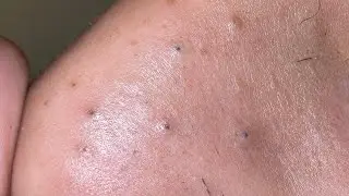 Korean Skincare ASMR | Deep Pore Cleansing Routine | Blackhead Removal & Final Glow 