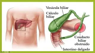 Colelitiasis 1