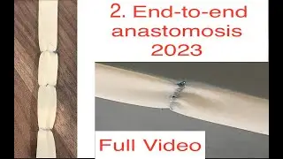 End-to-end vascular anastomosis, vertical, 2023, extended