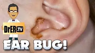 BUG IN MY EAR!  HORROR STORIES FROM THE ER!