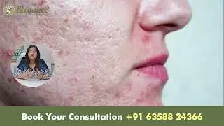 Visible Pores On Face, Treatment, Solution, Clinic, Best Dermatologist Doctor In Vesu, Piplod, Surat