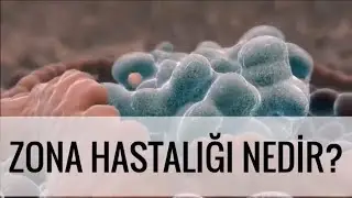 ZONA HASTALIĞI NEDİR ?