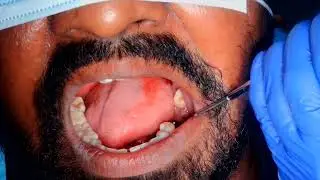 Failed rc treated teeth extraction with replacement of single piece compressive implant