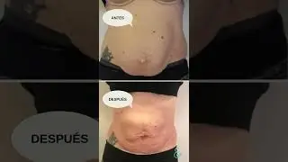 Rehabilitación de diástasis abdominal en 9 semanas