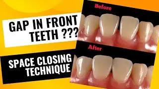 🫢🫢How Tooth Gaps Are Filled | Midline diastema closure | your dentist